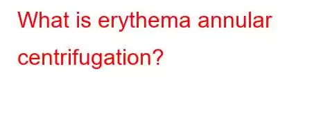 What is erythema annular centrifugation?