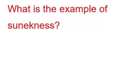 What is the example of sunekness